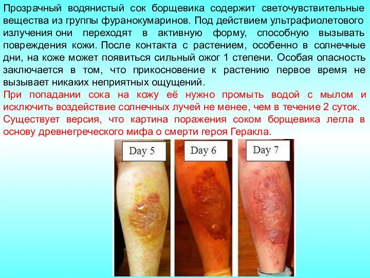 Прозрачный водянистый сок борщевика содержит светочувствительные вещества из группы фуранокумаринов.