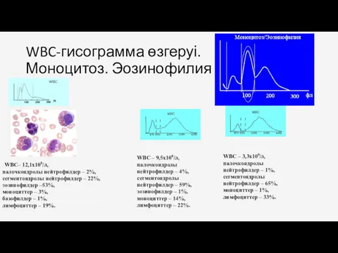 WBC-гисограмма өзгеруі. Моноцитоз. Эозинофилия . WBC– 12,1х109/л, палочкоядролы нейтрофилдер –