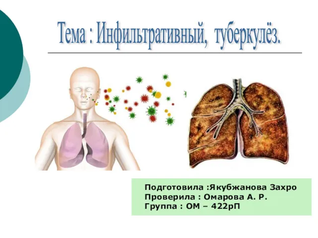 Тема : Инфильтративный, туберкулёз. Подготовила :Якубжанова Захро Проверила : Омарова