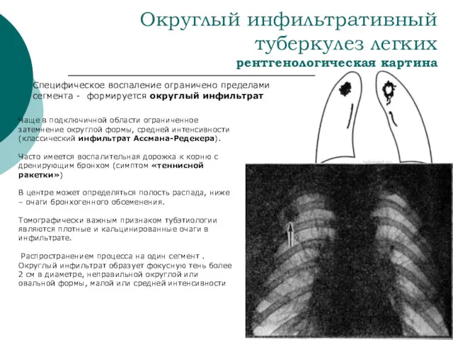 Округлый инфильтративный туберкулез легких рентгенологическая картина Чаще в подключичной области