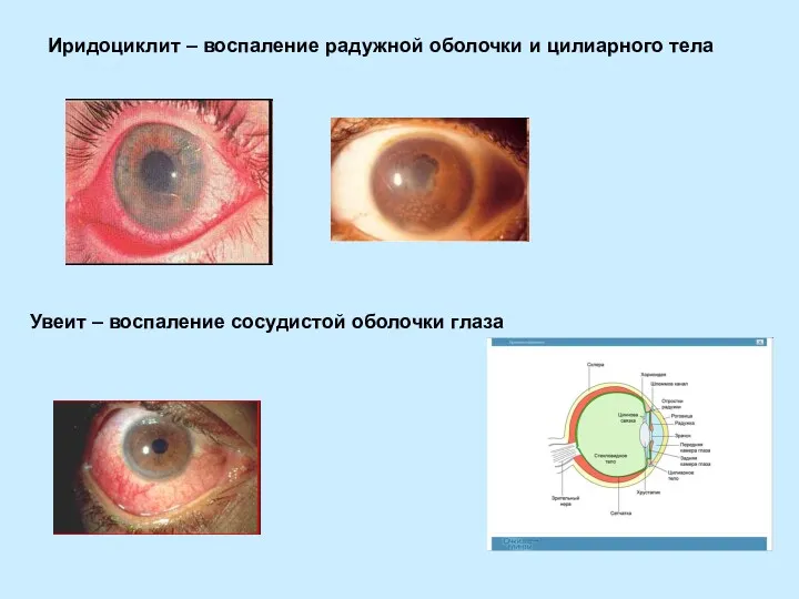 Иридоциклит – воспаление радужной оболочки и цилиарного тела Увеит – воспаление сосудистой оболочки глаза