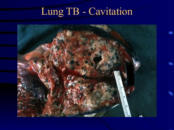 Lung TB - Cavitation