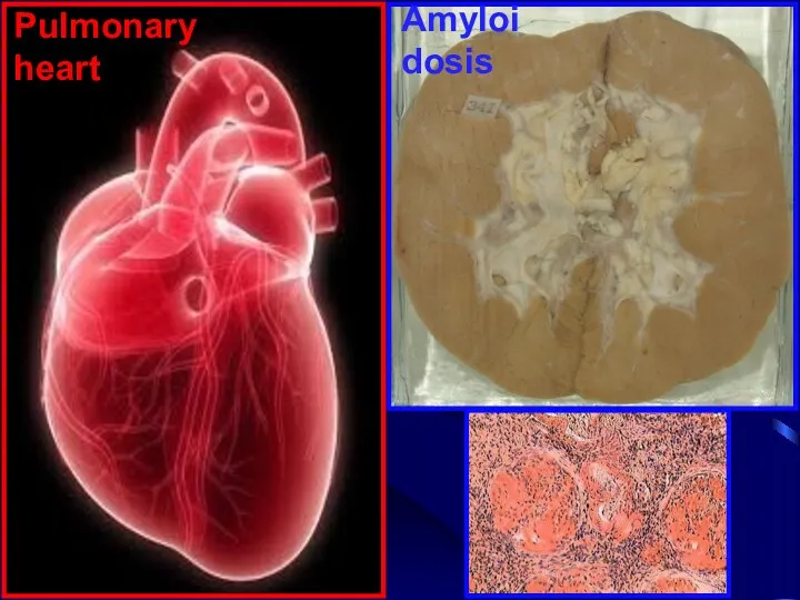 Pulmonary heart Amyloidosis
