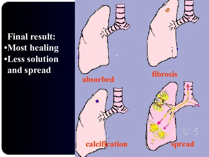 fibrosis absorbed calcification spread Final result: Most healing Less solution and spread