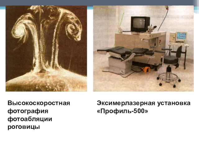 Высокоскоростная фотография фотоабляции роговицы Эксимерлазерная установка «Профиль-500»