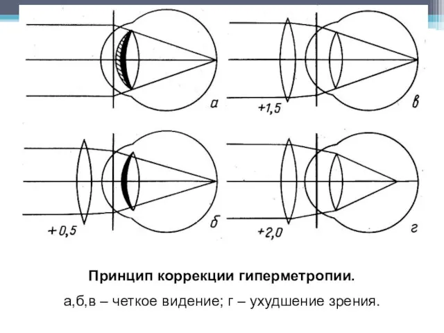 Принцип коррекции гиперметропии. а,б,в – четкое видение; г – ухудшение зрения.