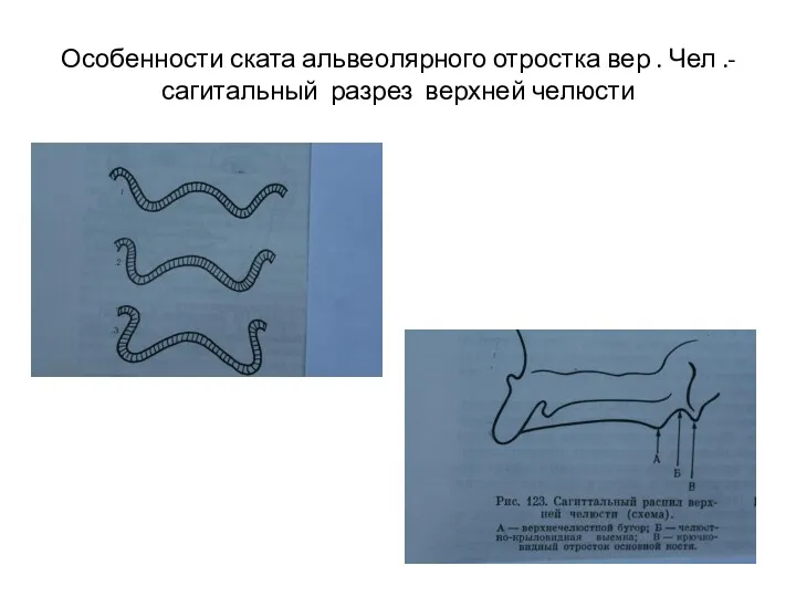Особенности ската альвеолярного отростка вер . Чел .-сагитальный разрез верхней челюсти