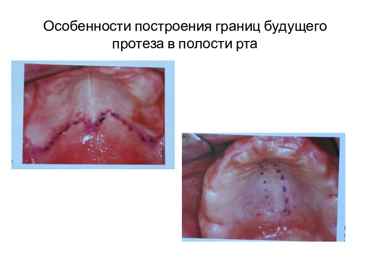 Особенности построения границ будущего протеза в полости рта