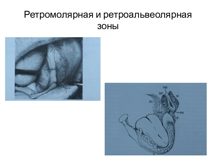 Ретромолярная и ретроальвеолярная зоны