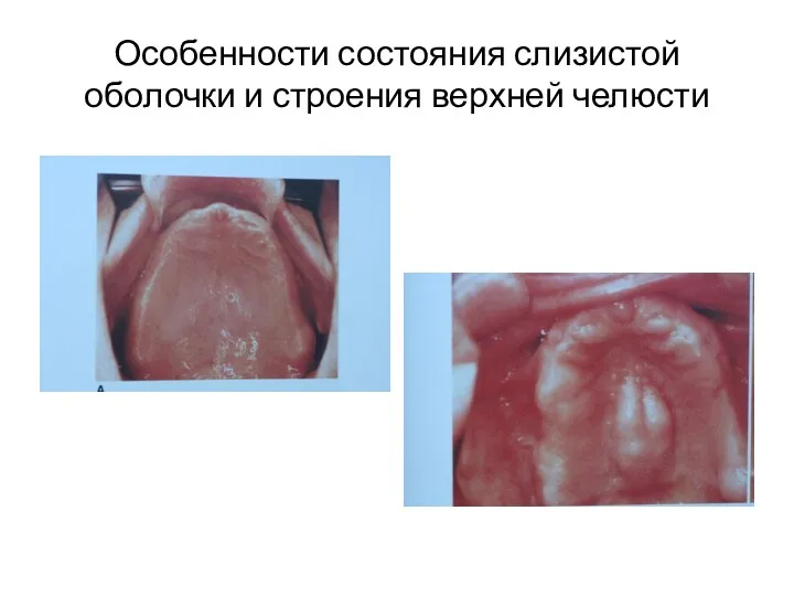 Особенности состояния слизистой оболочки и строения верхней челюсти