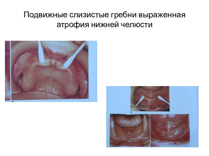 Подвижные слизистые гребни выраженная атрофия нижней челюсти