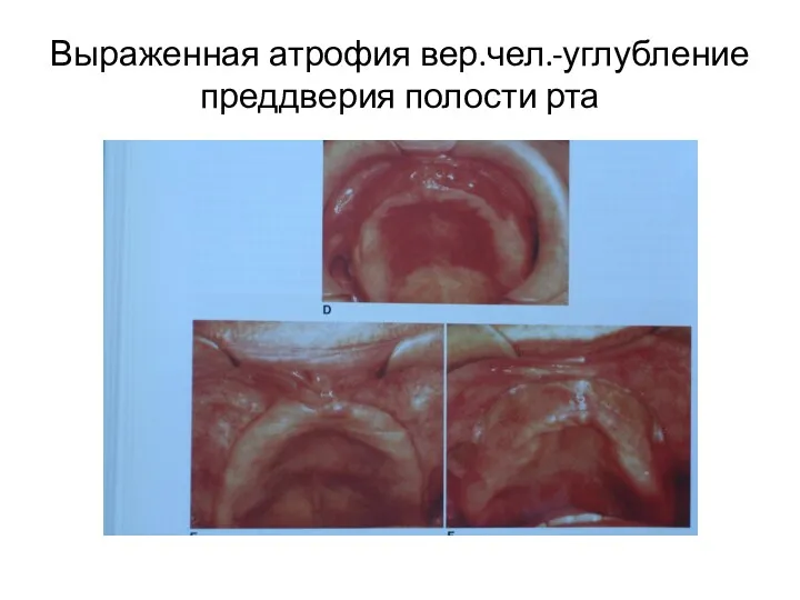 Выраженная атрофия вер.чел.-углубление преддверия полости рта