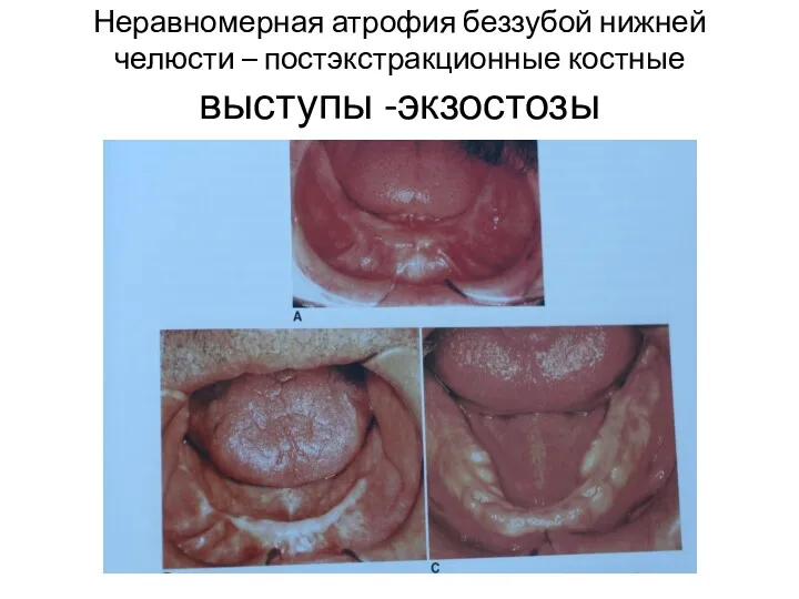 Неравномерная атрофия беззубой нижней челюсти – постэкстракционные костные выступы -экзостозы