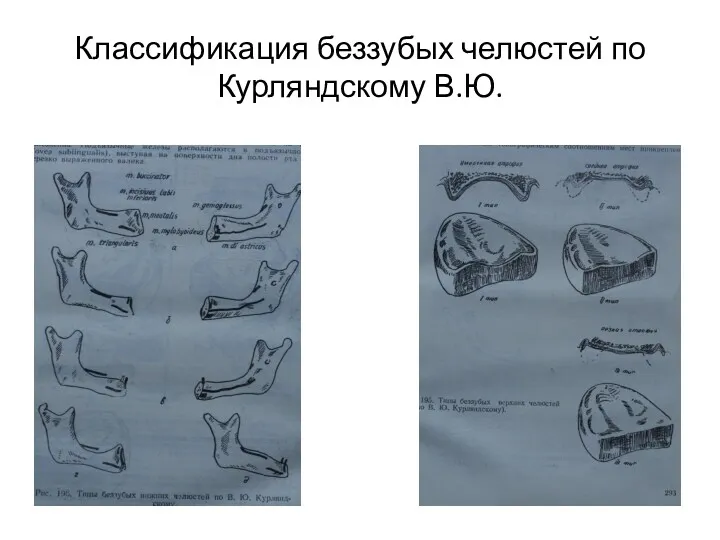 Классификация беззубых челюстей по Курляндскому В.Ю.