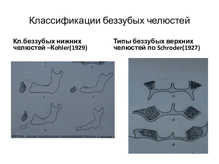 Классификации беззубых челюстей Кл.беззубых нижних челюстей –Кohler(1929) Типы беззубых верхних челюстей по Schroder(1927)