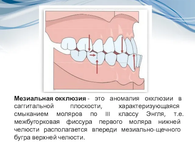 Мезиальная окклюзия - это аномалия окклюзии в саггитальной плоскости, характеризующаяся