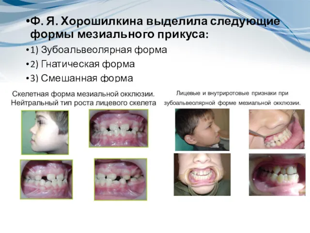Ф. Я. Хорошилкина выделила следующие формы мезиального прикуса: 1) Зубоальвеолярная