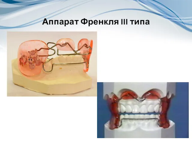 Аппарат Френкля III типа