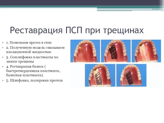 Реставрация ПСП при трещинах 1. Помещаем протез в гипс 2.