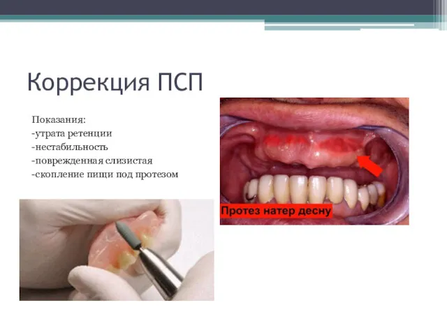 Коррекция ПСП Показания: -утрата ретенции -нестабильность -поврежденная слизистая -скопление пищи под протезом