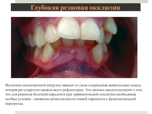 Глубокая резцовая окклюзия Величина окклюзионной нагрузки зависит от силы сокращения