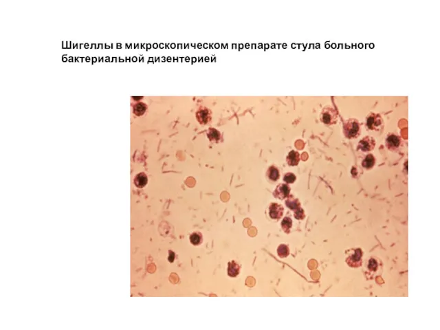 Шигеллы в микроскопическом препарате стула больного бактериальной дизентерией