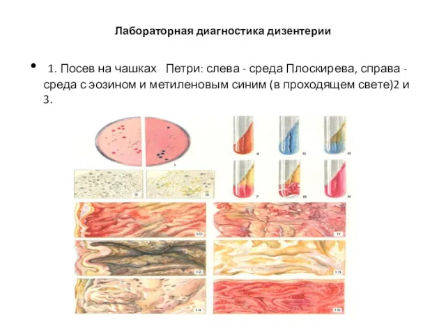 Лабораторная диагностика дизентерии 1. Посев на чашках Петри: слева -