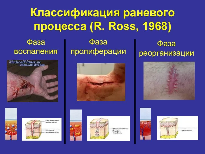 Классификация раневого процесса (R. Ross, 1968) Фаза воспаления Фаза реорганизации Фаза пролиферации