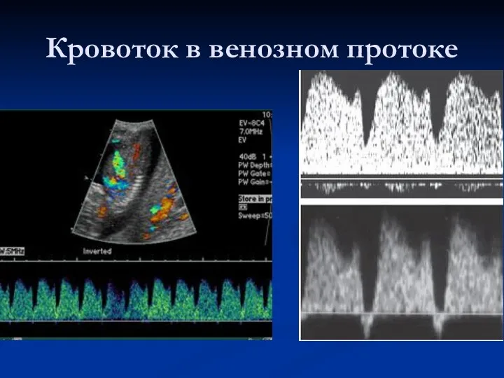Кровоток в венозном протоке