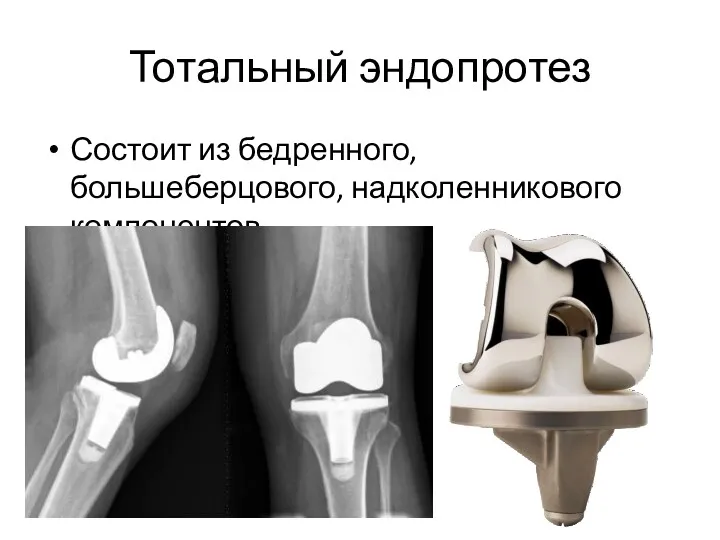 Тотальный эндопротез Состоит из бедренного, большеберцового, надколенникового компонентов