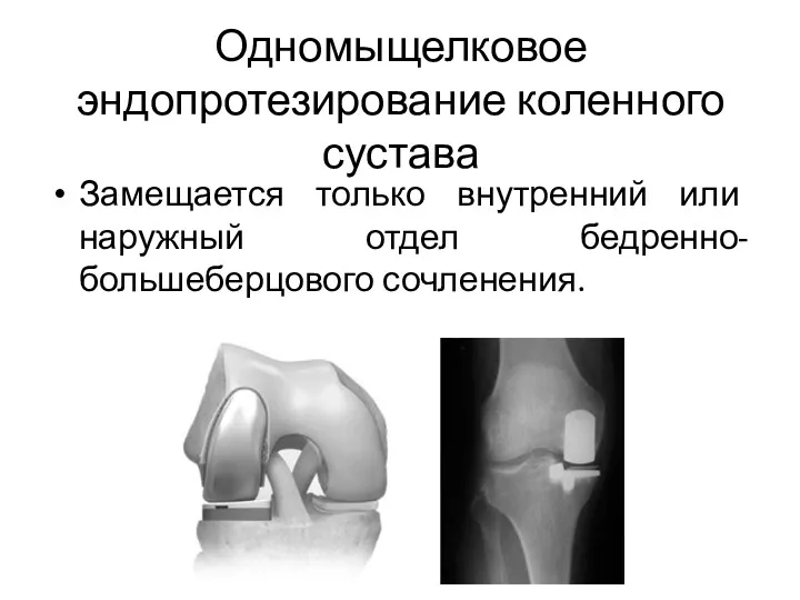 Одномыщелковое эндопротезирование коленного сустава Замещается только внутренний или наружный отдел бедренно-большеберцового сочленения.