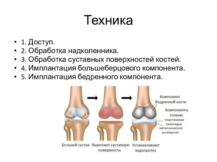 Техника 1. Доступ. 2. Обработка надколенника. 3. Обработка суставных поверхностей