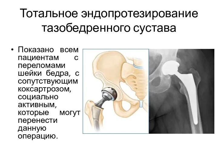 Тотальное эндопротезирование тазобедренного сустава Показано всем пациентам с переломами шейки