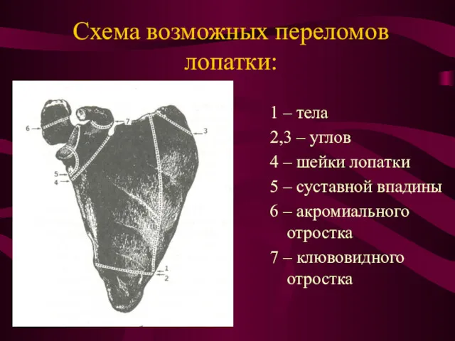 Схема возможных переломов лопатки: 1 – тела 2,3 – углов