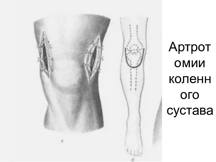 Артротомии коленного сустава