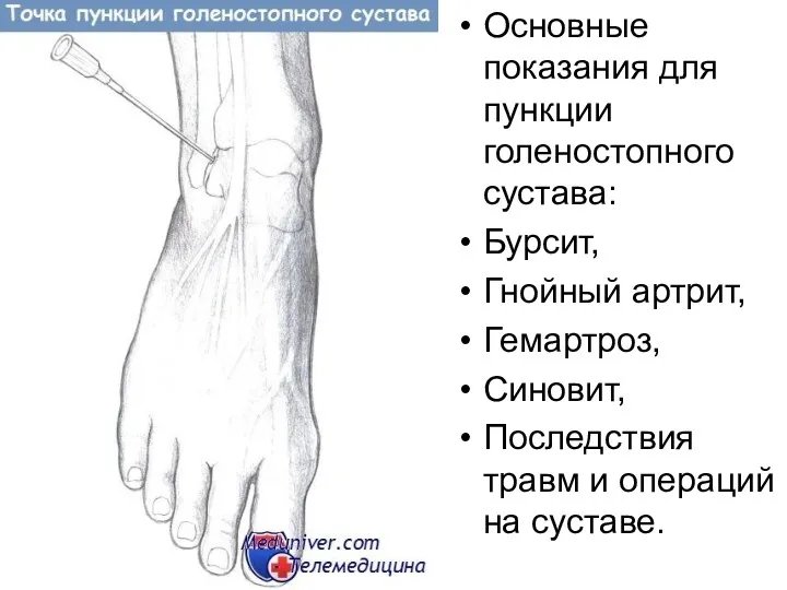 Основные показания для пункции голеностопного сустава: Бурсит, Гнойный артрит, Гемартроз,