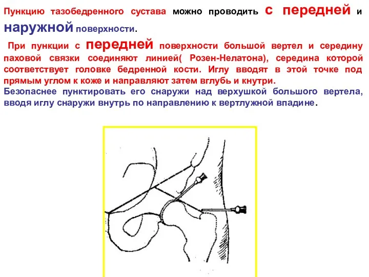 Пункцию тазобедренного сустава можно проводить с передней и наружной поверхности.