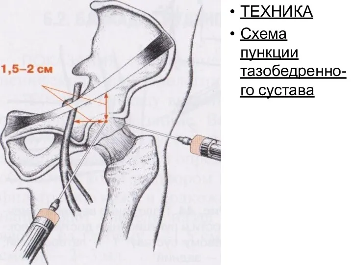 ТЕХНИКА Схема пункции тазобедренно-го сустава