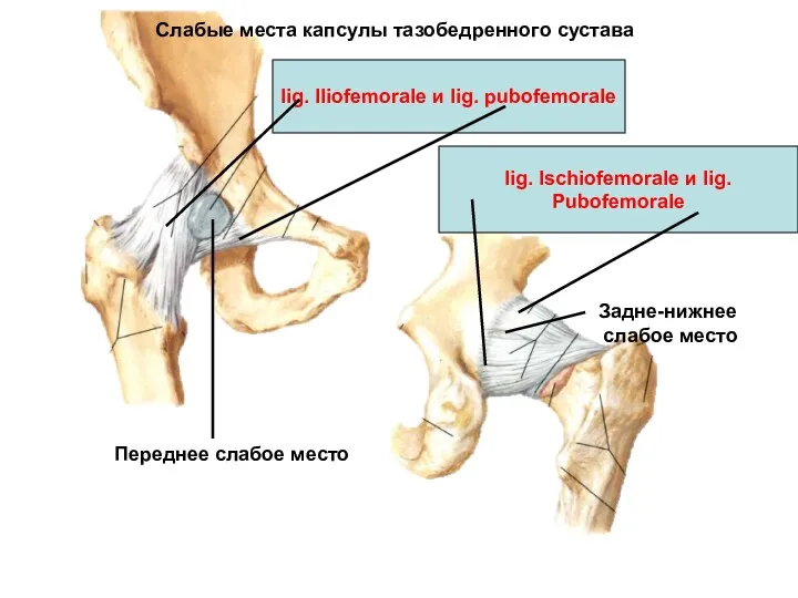 Слабые места капсулы тазобедренного сустава Переднее слабое место Задне-нижнее слабое