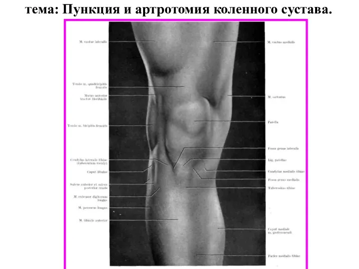 тема: Пункция и артротомия коленного сустава.
