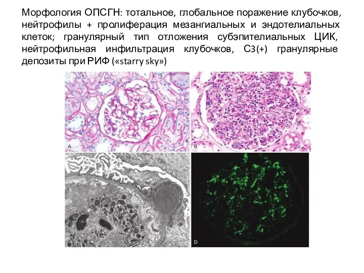 Морфология ОПСГН: тотальное, глобальное поражение клубочков, нейтрофилы + пролиферация мезангиальных