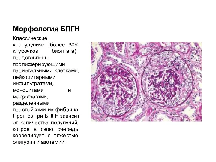 Морфология БПГН Классические «полулуния» (более 50% клубочков биоптата) представлены пролиферирующими