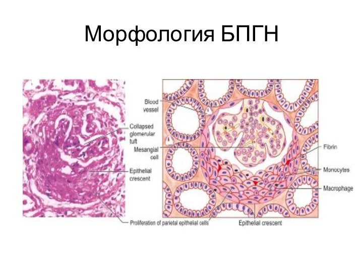 Морфология БПГН