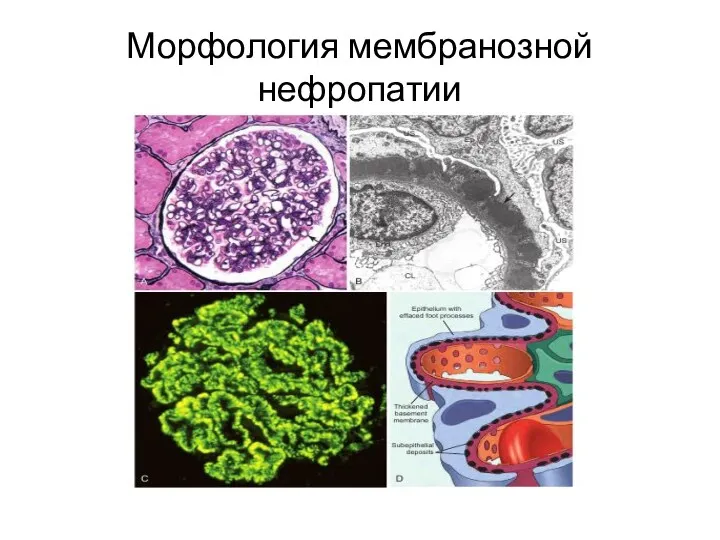 Морфология мембранозной нефропатии