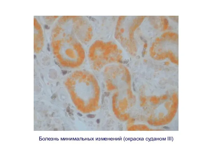 Болезнь минимальных изменений (окраска суданом III)