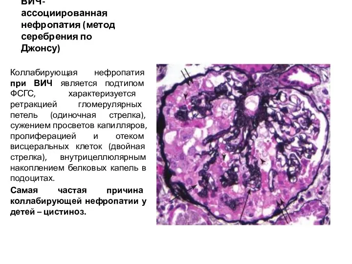 ВИЧ- ассоциированная нефропатия (метод серебрения по Джонсу) Коллабирующая нефропатия при
