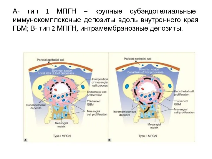 А- тип 1 МПГН – крупные субэндотелиальные иммунокомплексные депозиты вдоль