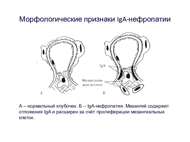 Морфологические признаки IgA-нефропатии А – нормальный клубочек. Б – IgA-нефропатия.