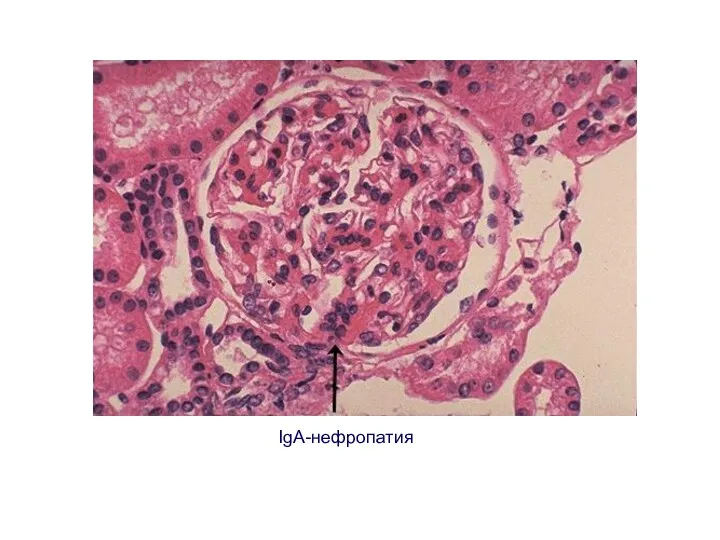 IgA-нефропатия