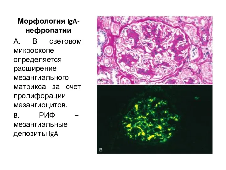Морфология IgA-нефропатии А. В световом микроскопе определяется расширение мезангиального матрикса